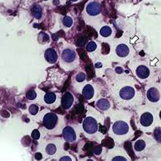 Gram Stain of Bronchoalveolar Lavage (BAL)